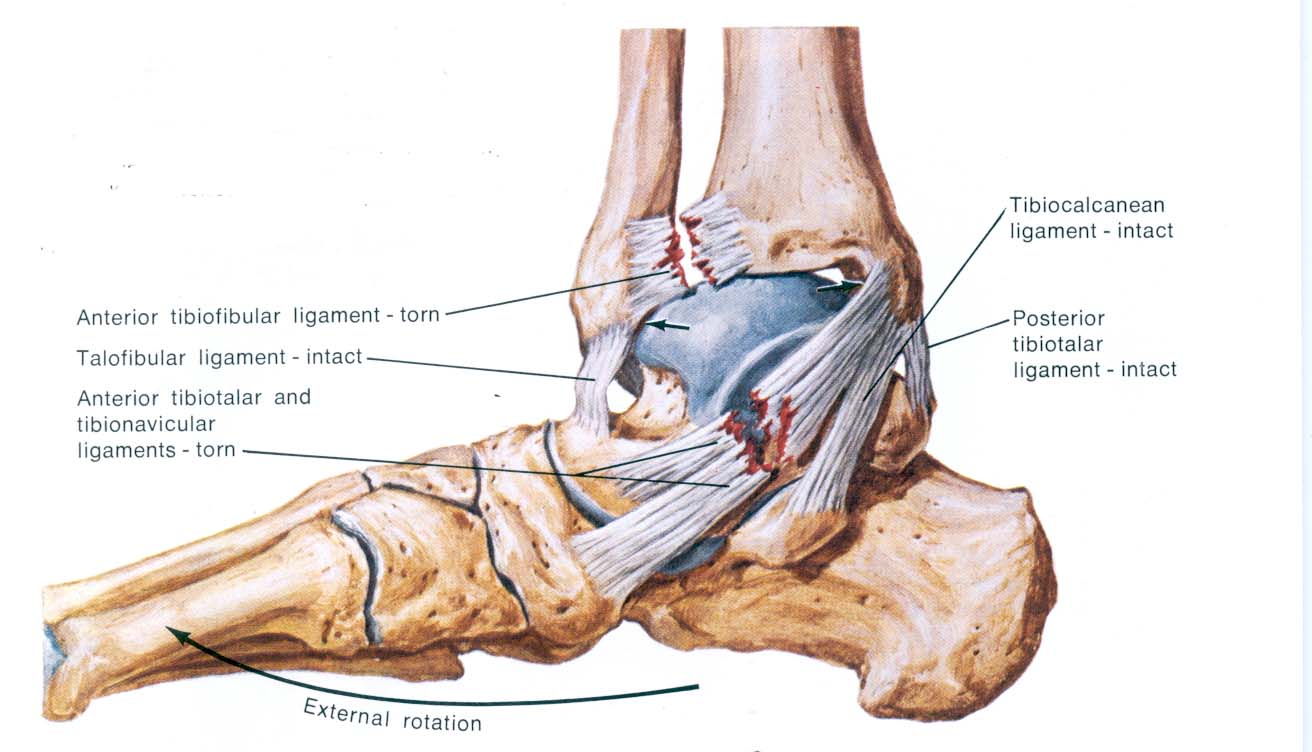 A New Twist on Ankle Sprains